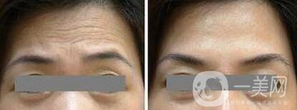 怎樣去抬頭紋 如何消除抬頭紋