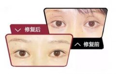 眼窩凹陷手術(shù)介紹 什么是眼窩凹陷手術(shù)