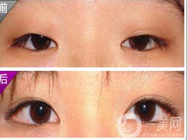 開內(nèi)外眼角,*果