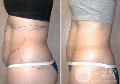 鐳射溶脂副作用？鐳射溶脂*果怎么樣