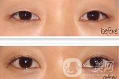 手術(shù)開(kāi)眼角要多少錢(qián) 開(kāi)眼角的費(fèi)用