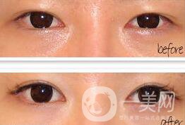 手術(shù)開眼角要多少錢 開眼角的費用