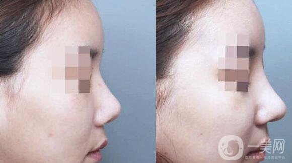 硅膠假體隆鼻怎么樣 硅膠隆鼻能保持幾年