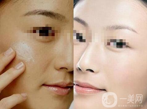 光子嫩膚*嗎 光子嫩膚好不好