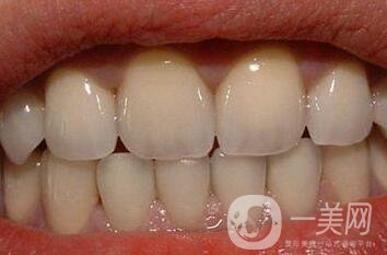 金鈀合金烤瓷牙優(yōu)缺點詳細介紹