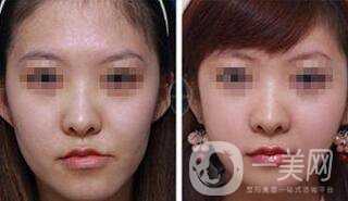 打玻尿酸后注意什么 注射玻尿酸如何護理