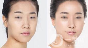 打玻尿酸后注意什么 注射玻尿酸如何護理