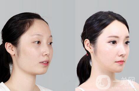 磨腮削骨多少錢(qián)？腮幫子磨骨多少錢(qián)？