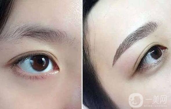 北京眉整形多少錢？?jī)r(jià)格是多少？