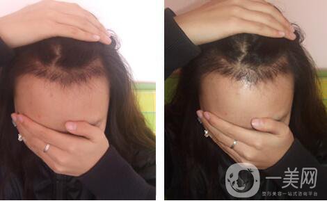 鄭州,頭發(fā)移植,醫(yī)院