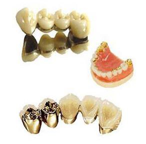 北京貴金屬烤瓷牙多少錢 貴金屬烤瓷牙價格詳解