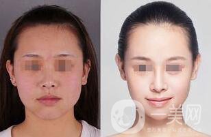 像素激光美容多少錢(qián) 像素激光美容價(jià)格詳解