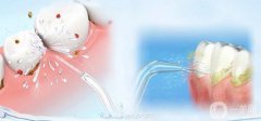 洗牙的利與弊 洗牙的優(yōu)點和缺點