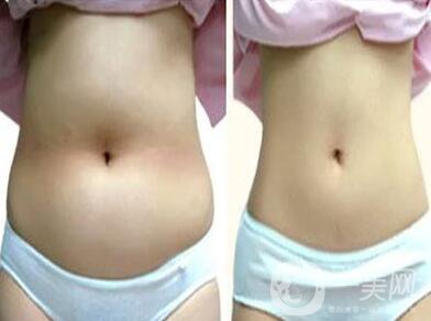 360吸脂減肥,多少錢