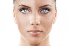 果酸換膚的危害 后遺癥主要有哪些？