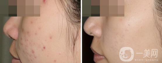 果酸換膚的危害 后遺癥主要有哪些？