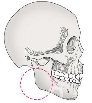 下頜角截骨手術(shù)頭套戴多久 恢復(fù)期要多久？