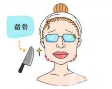 下頜角截骨手術(shù)頭套戴多久 恢復(fù)期要多久？