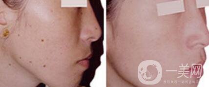去痣的價格 祛痣一般多少錢
