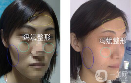 北京東方和諧馮斌整形價格表2018國慶特惠出爐