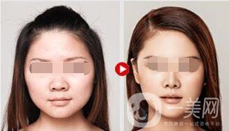 溶脂多少錢 溶脂具體價格透露