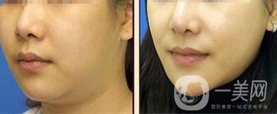 溶脂多少錢 溶脂具體價格透露