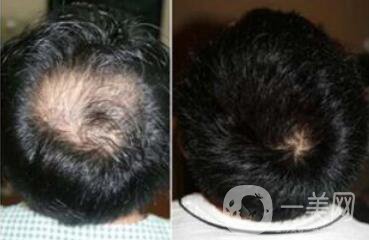 蛋白纖維植發(fā)多少錢 北京蛋白纖維植發(fā)價(jià)格