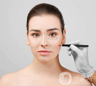 駝峰鼻矯正注意事項有哪些？