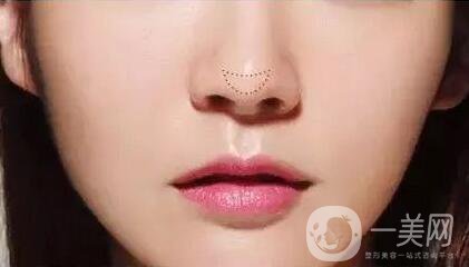 歪鼻矯正注意事項(xiàng)有哪些？