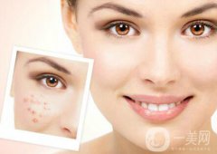 像素激光調(diào)節(jié)痘坑果怎么樣？