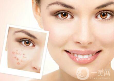 像素激光調(diào)節(jié)痘坑*果怎么樣？