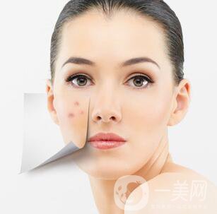 像素激光調(diào)節(jié)痘坑*果怎么樣？