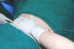 超聲波抽脂*嗎？有什么風險？