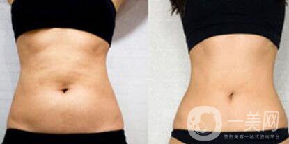 超聲波抽脂價格多少？超聲波抽脂有什么優(yōu)點？