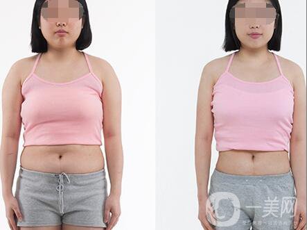 超聲波抽脂價格多少？超聲波抽脂有什么優(yōu)點？