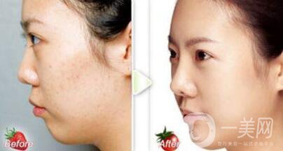 正規(guī)醫(yī)院做果酸換膚要多少錢？