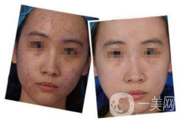 正規(guī)醫(yī)院做果酸換膚要多少錢？