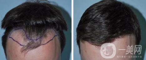 fue植發(fā)缺點和優(yōu)點分別是什么