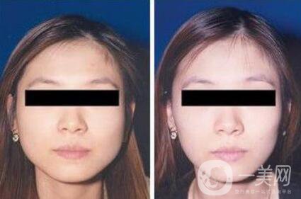 打完*能維持多長時間