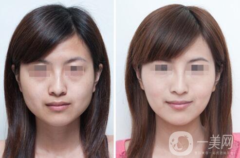 打完*能維持多長時間