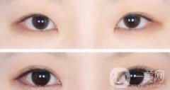 開眼角手術醫(yī)院介紹？開眼角哪好？