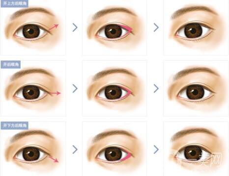 開眼角手術(shù)醫(yī)院介紹？開眼角哪好？