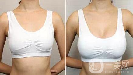 做豐胸手術(shù)時會痛嗎 術(shù)后恢復痛嗎