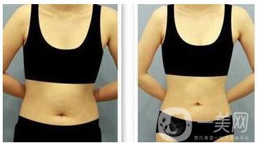 深圳腰腹部溶脂價(jià)格需要多少錢(qián)