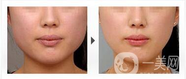 成都注射*一針多少錢