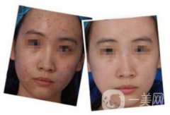 杭州做個(gè)果酸換膚大概多少錢(qián)