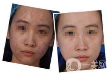 杭州做個(gè)果酸換膚大概多少錢