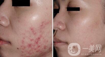 杭州做個(gè)果酸換膚大概多少錢