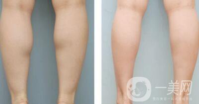 在深圳打*一般多少錢