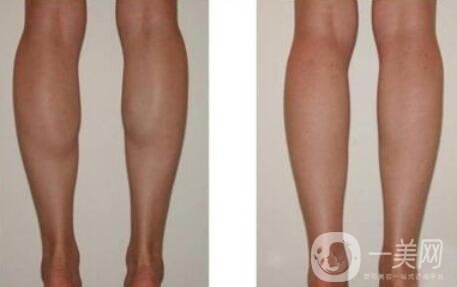 在深圳打*一般多少錢